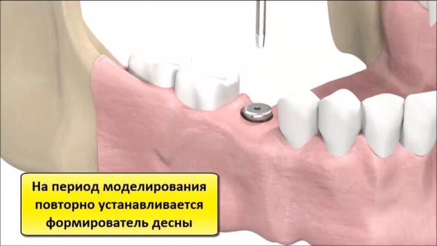 Установка десны. Dio-Implant формирователь десны. Имплант формирователь абатмент. Формирователь на имплант Osstem. Имплант формирователь коронка.