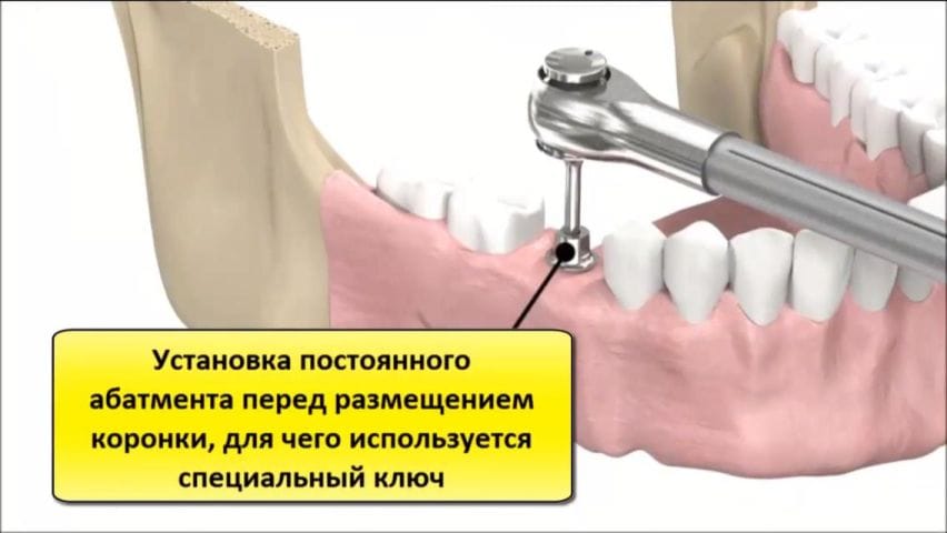 Абатмент на имплант. Абатмент. Установка постоянного абатмента. Способы крепления коронки к абатменту.